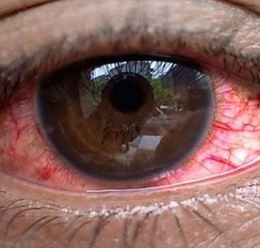7 bin 500 kişide "kırmızı göz" hastalığı görüldü